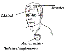 Text Box:  
Unilateral implantation
