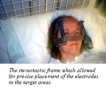 Text Box:  
The stereotactic frame that holds the head rigid, thus allowing for precise placement of the electrode
